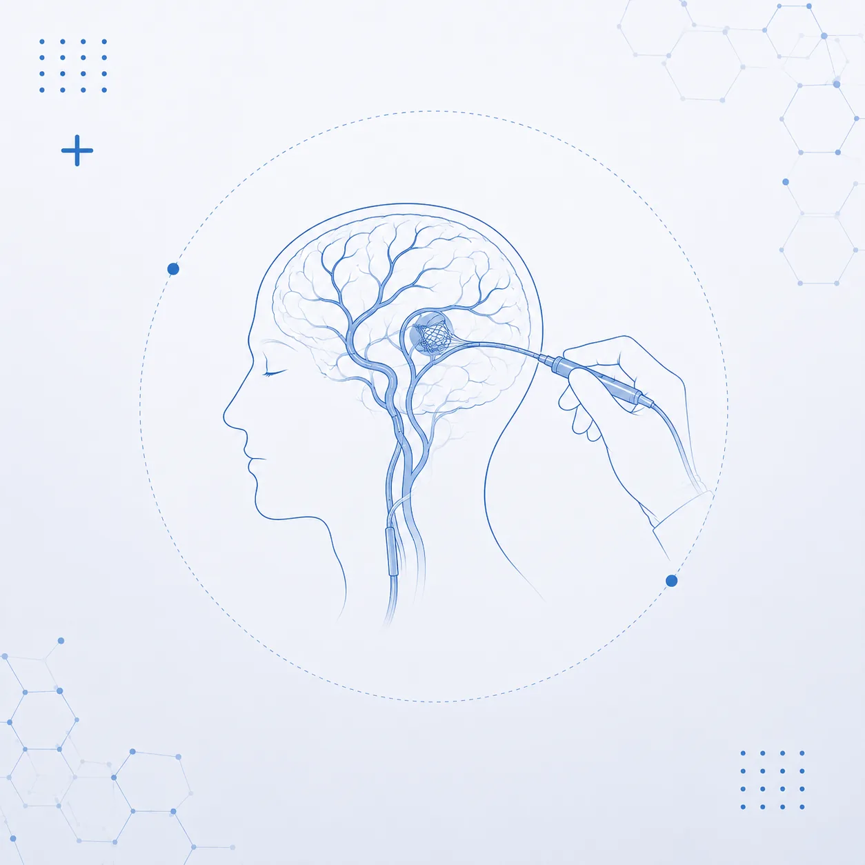 Neurorradiologia de Intervenção